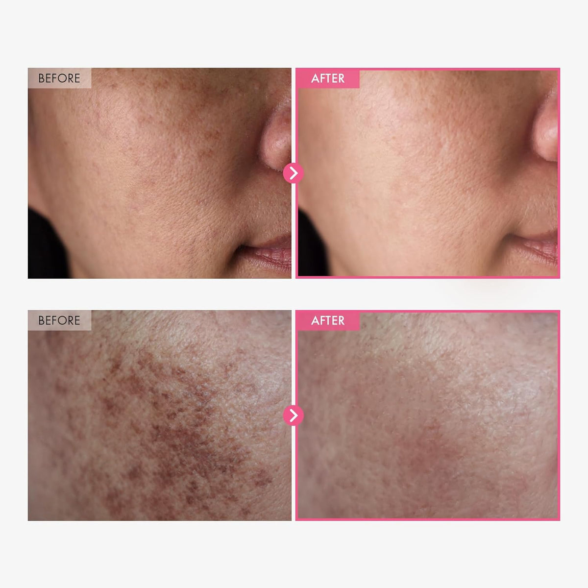 Arbutin 7% + Tranexamic Acid 4% Cream for Dark Spots, Brightening